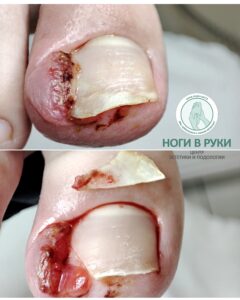 вросший ноготь