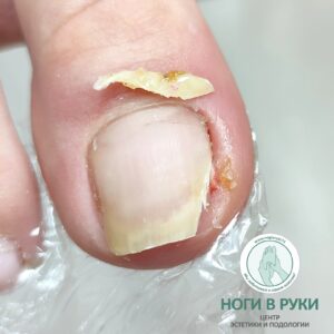 вросший ноготь