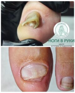 коррекция ногтя